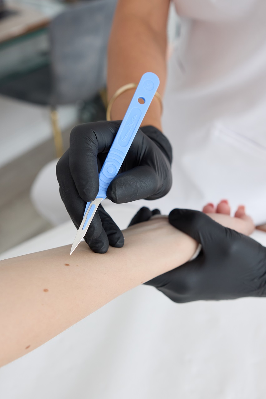 Chirurgiczne usuwanie zmian skórnych