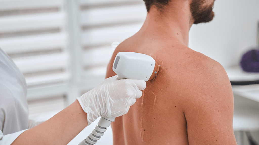 Depilacja laserowa pleców