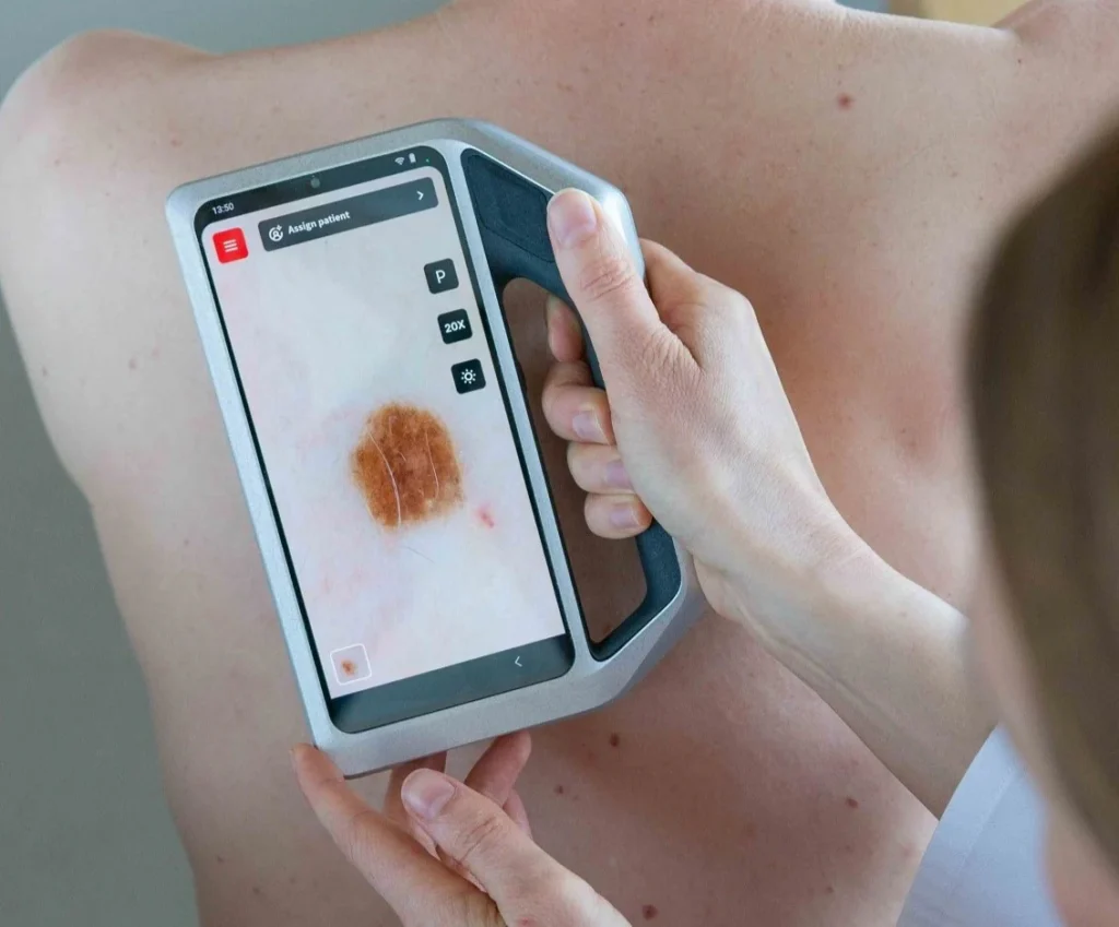 Dermatoskopia