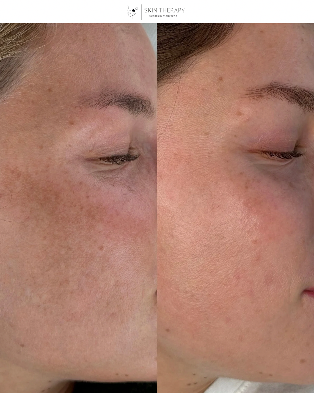 Laserowe usuwanie przebarwień – 10