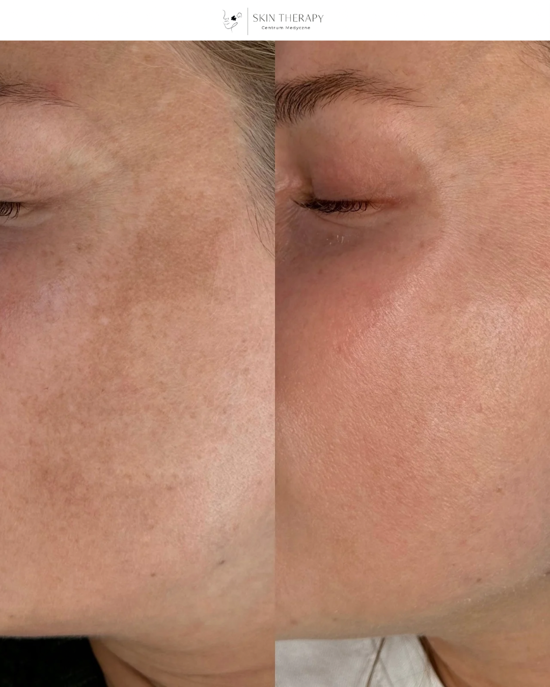 Laserowe usuwanie przebarwień – 11