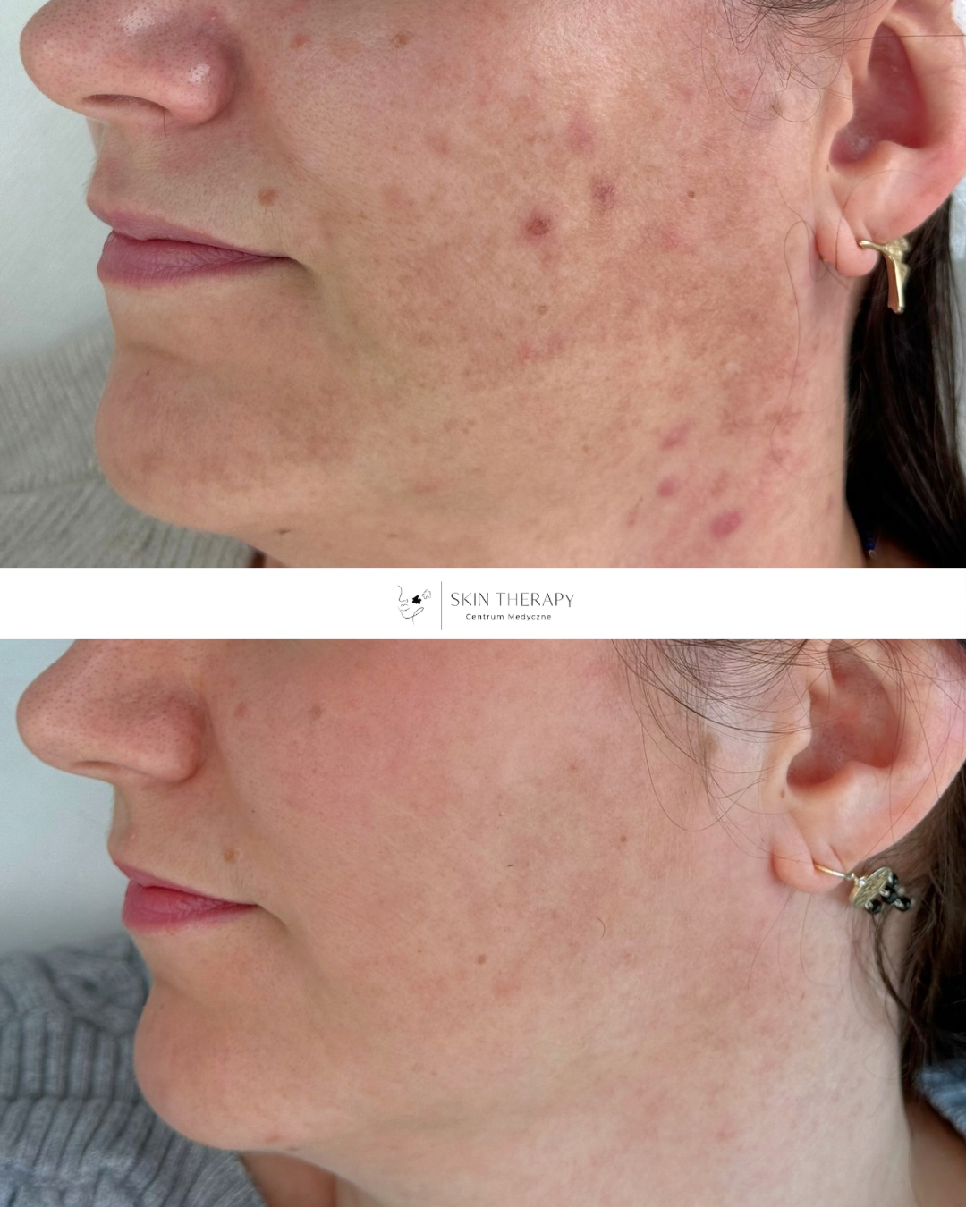 Laserowe usuwanie przebarwień – 7