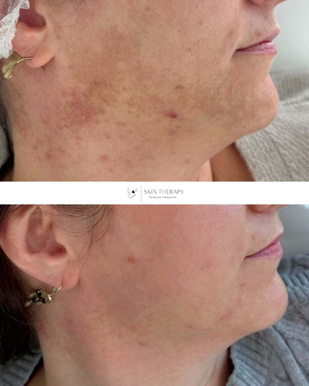 Laserowe usuwanie przebarwień – 8