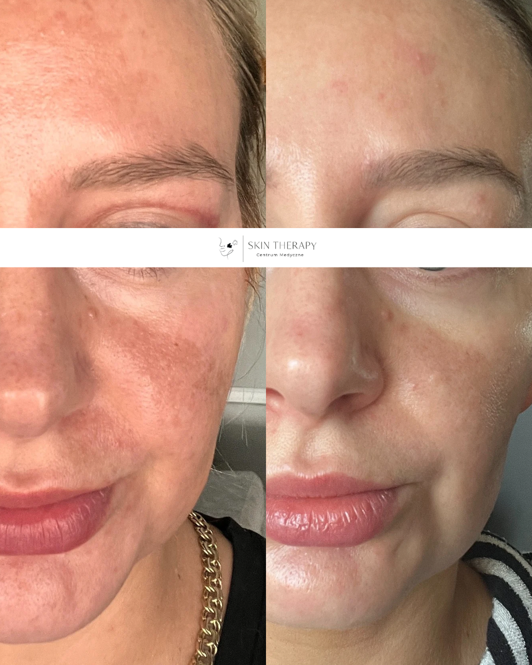 Laserowe usuwanie przebarwień – 4