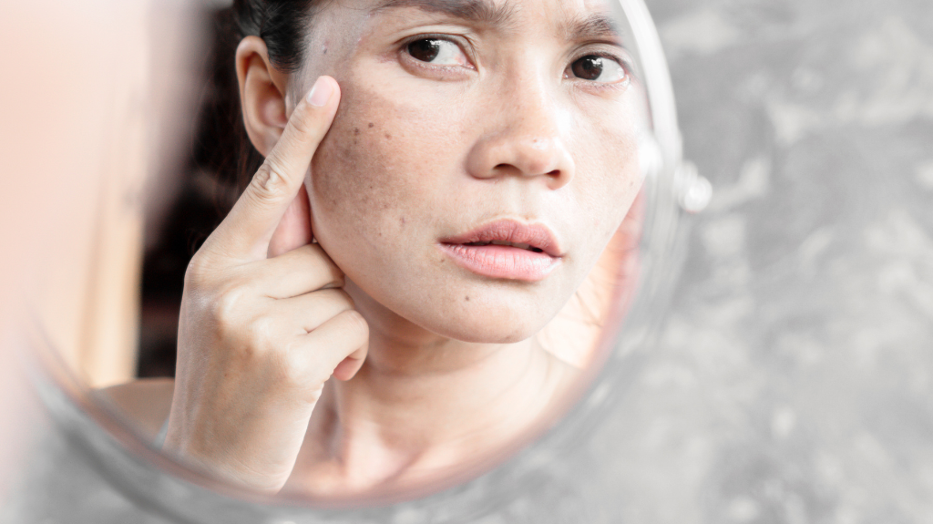 Laserowe usuwanie przebarwień laserem Fotona StarWalker® MaQX