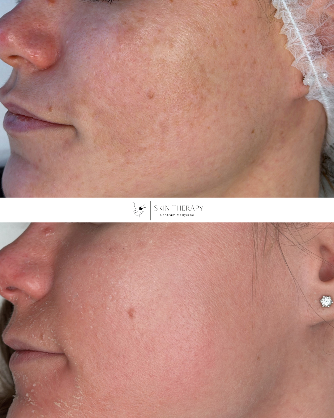 Laserowe usuwanie przebarwień – 3