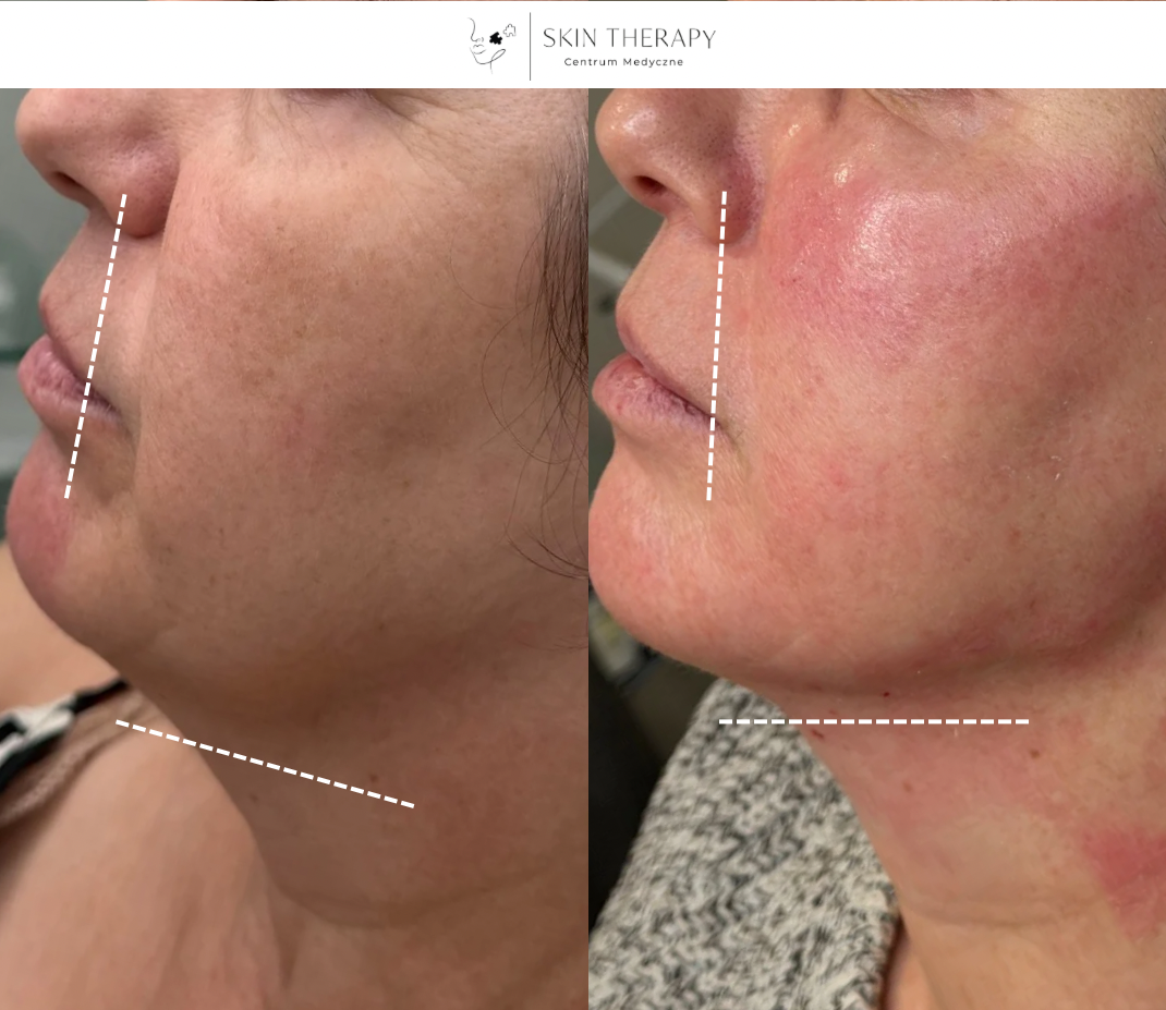 Autologiczny wypełniacz z krwi