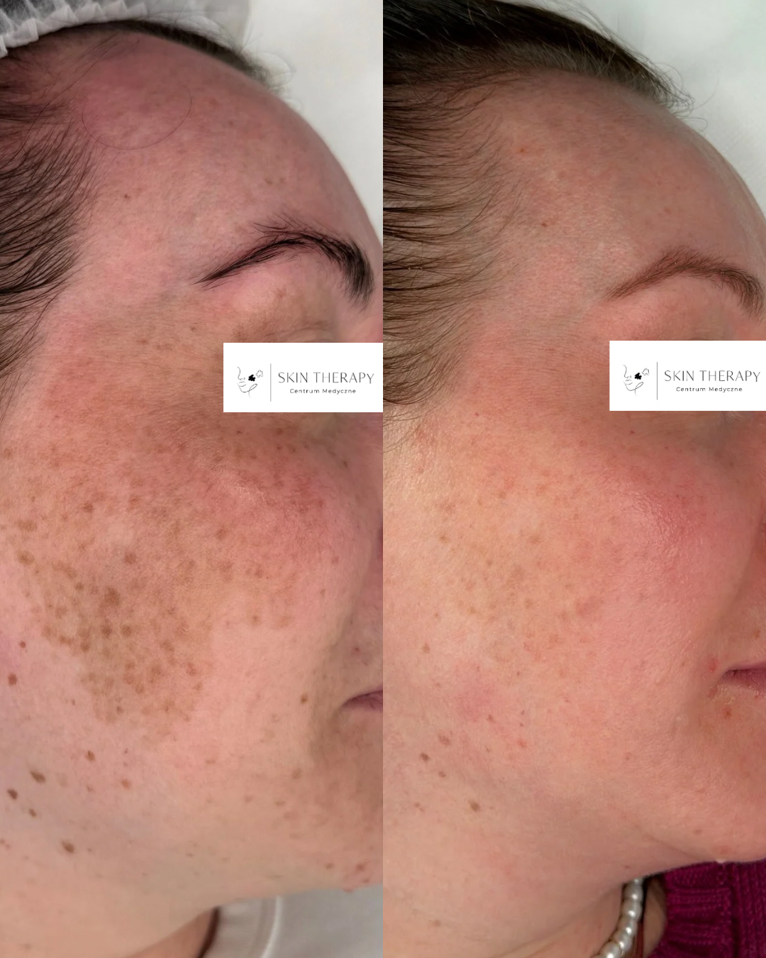 Laserowe usuwanie przebarwień – 1