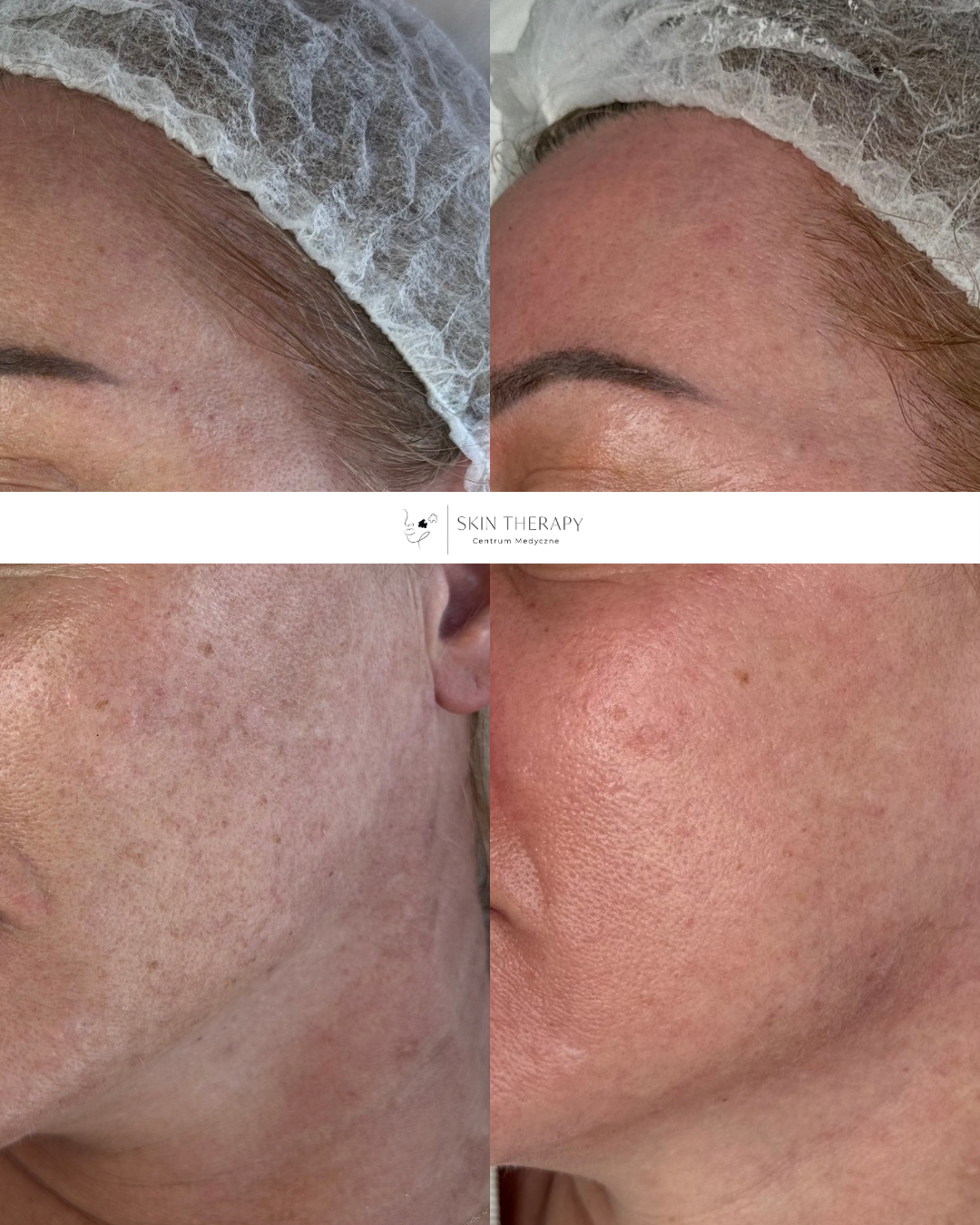 Laserowe usuwanie przebarwień – 6