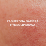 Zaburzona bariera hydrolipidowa- jak ją rozpoznać i prawidłowo odbudować?