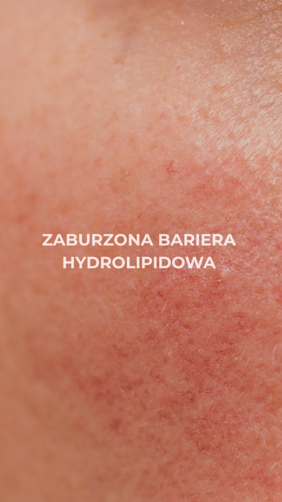 Zaburzona bariera hydrolipidowa- jak ją rozpoznać i prawidłowo odbudować?