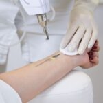 Laserowe usuwanie tatuażu